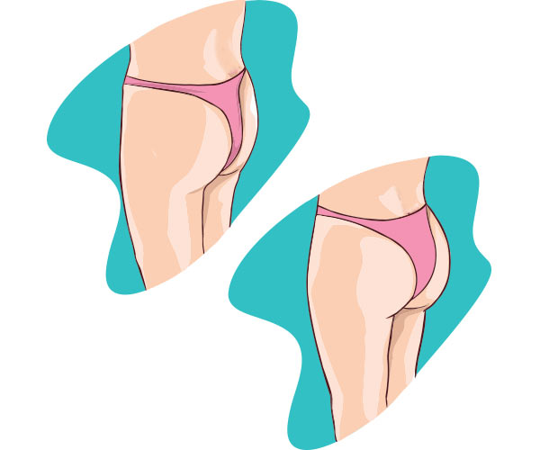 کاندیدهای تزریق چربی در باسن