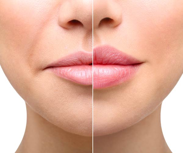 نحوه تزریق ژل لب