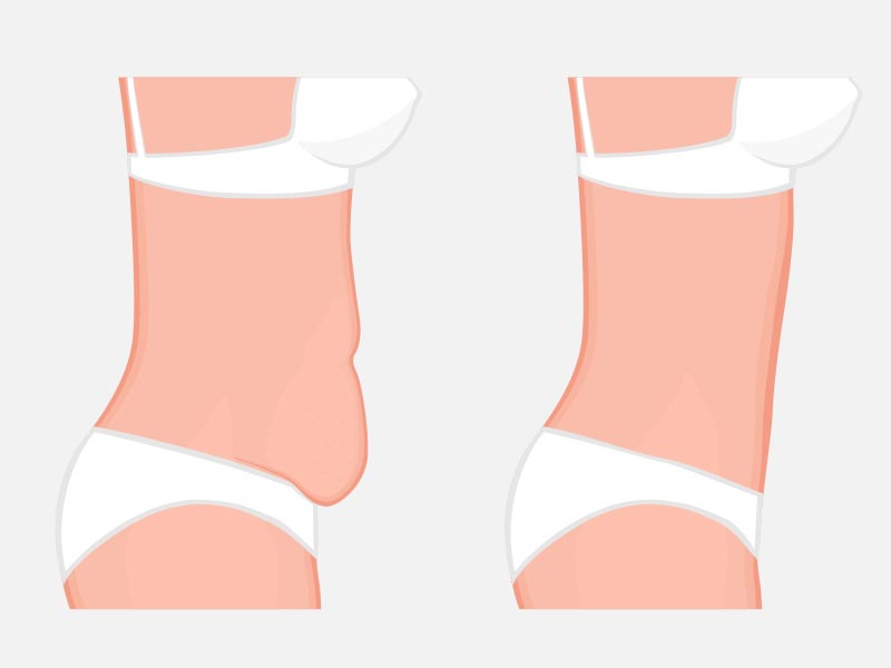 چگونه چربی‌های شکم و پهلو را از بین ببریم؟