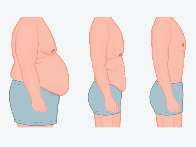 مزایا و معایب آبدومینوپلاستی