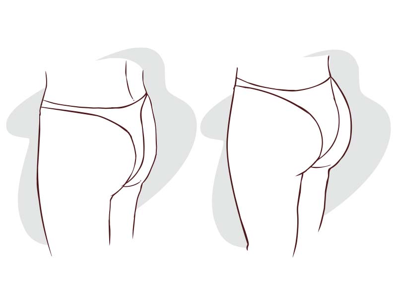 فرم دهی باسن با چربی چه عوارضی دارد