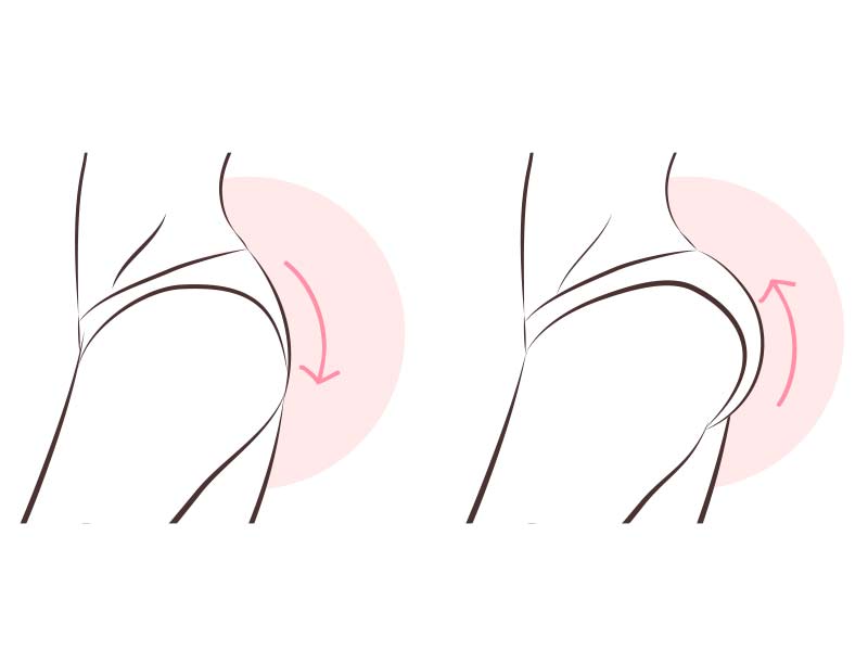 تزریق چربی به باسن