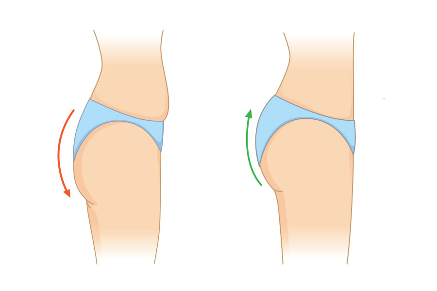 ماندگاری فرمدهی باسن با چربی
