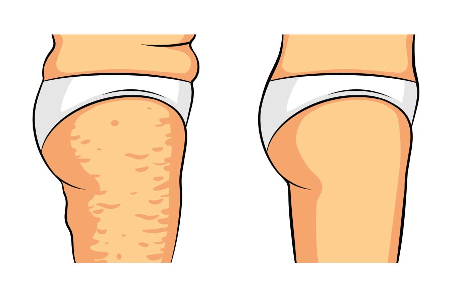 مزایا و معایب لیفت ران