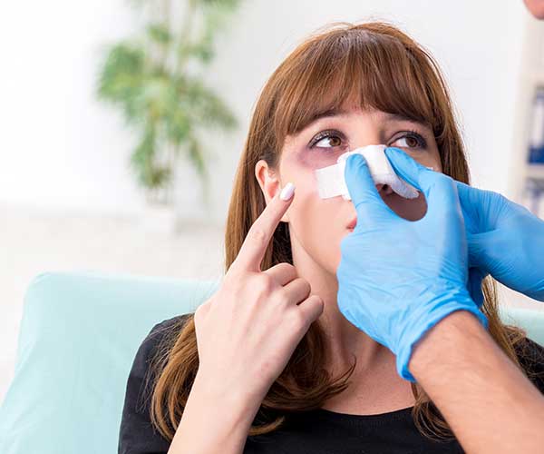 کبودی بعد از جراحی بینی