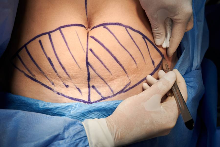جراحی آبدومینوپلاستی