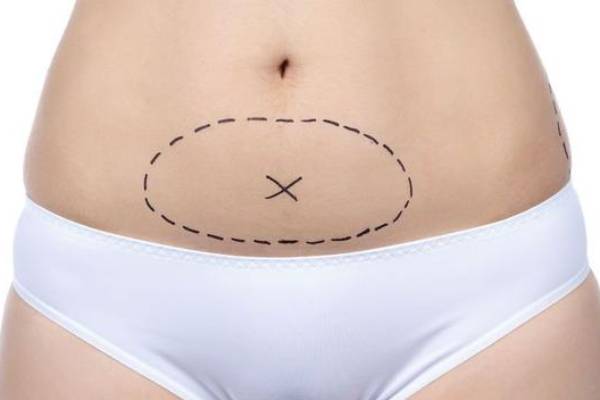 بازگشت ابدومینوپلاستی